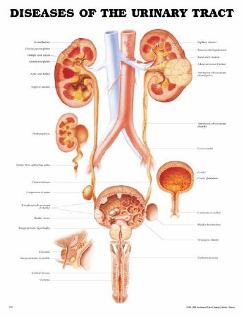 Anatomical Chart Company - Anatomical Chart Diseases of the Urinary Tract 20 X 26 Inch Plastic Grommets Laminated - 9781587792410