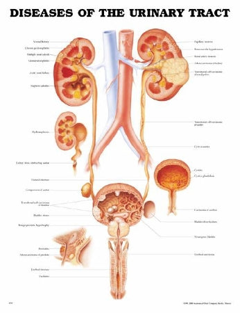 Anatomical Chart Company Anatomical Chart Diseases of the Urinary Tract 20 X 26 Inch Plastic Grommets Laminated - 9781587792410