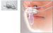 Nihon Kohden America - Nasal Airway Adapter - YG-122T
