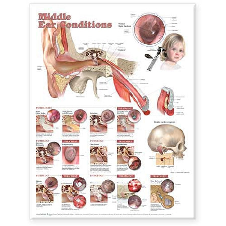 Anatomical Chart Company - Anatomical Chart Middle Ear Conditions 20 X 26 Inch Heavy Paper Grommets Laminated - 9781605470962