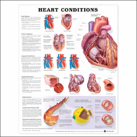 Anatomical Chart Company Anatomical Chart Heart Conditions 20 X 26 Inch Heavy Paper Laminated - 9781587798825