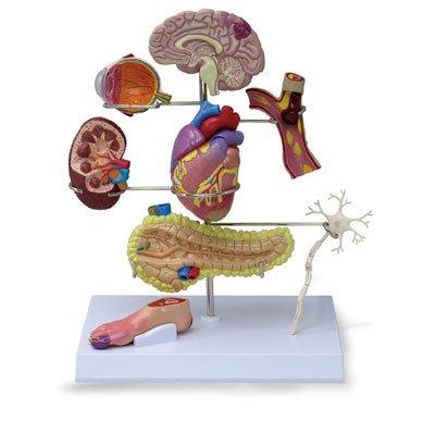 Nasco Healthcare - Type 2 Diabetes Model - SB46335