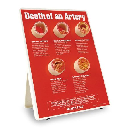 Nasco Healthcare - Death of an Artery Model - SB22334