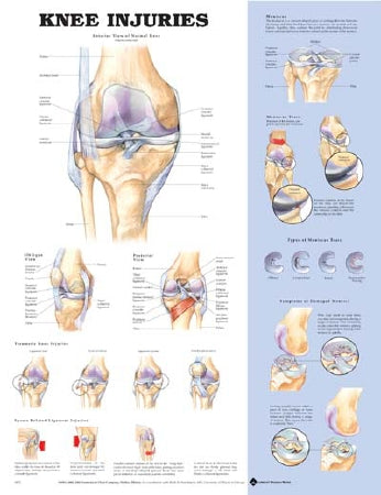 Anatomical Chart Company Anatomical Chart Knee Injuries 20 X 26 Inch Heavy Paper Laminated - 9781587797576