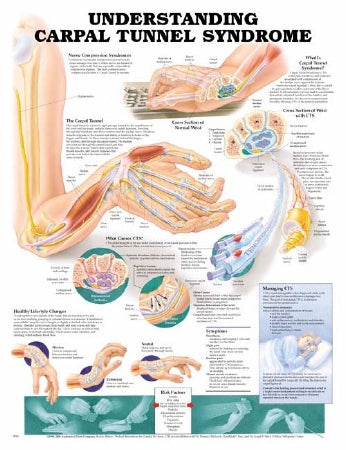 Anatomical Chart Company - Anatomical Chart Understanding Carpal Tunnel Syndrome 20 X 26 Inch Heavy Paper Grommets Laminated - 9781587793219