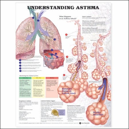 Anatomical Chart Company - Chart Understanding Asthma 20 X 26 Inch Paper Laminated - 9781587799389
