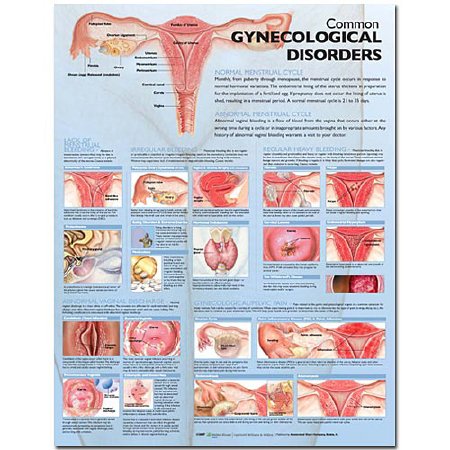 Anatomical Chart Company - Anatomical Chart Common Gynecological Disorders 20 X 26 Inch Paper Grommets Laminated - 9780781773508