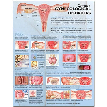 Anatomical Chart Company Anatomical Chart Common Gynecological Disorders 20 X 26 Inch Paper Grommets Laminated - 9780781773508