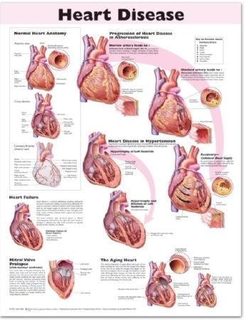 Anatomical Chart Company Anatomical Chart Heart Disease 20 X 26 Inch Heavy Paper Grommets Laminated - 9780781773386