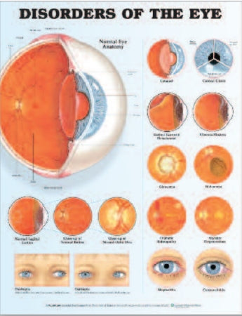 Anatomical Chart Company Anatomical Chart Eye Disorder 20 X 26 Inch Heavy Paper Grommets Laminated - 9781587799259