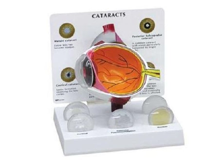 Anatomical Chart Company Cataract Eye Model - G280