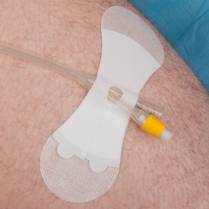 Baxter GRIP-LOK Catheter Stabilization Device 6.25 Long, Sterile, Breathable, Hypoallergenic Adhesive - 3400LFC