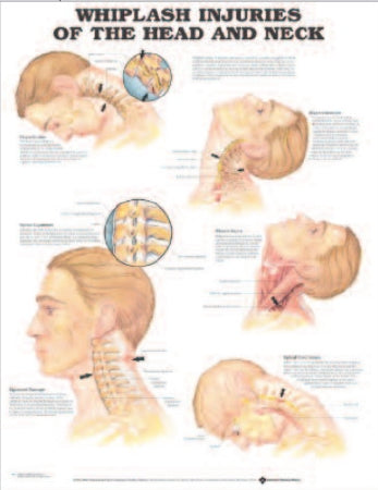 Anatomical Chart Company - Anatomical Chart Whiplash 20 X 26 Inch Heavy Paper Grommets Laminated - 9781587793752