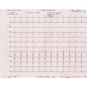 Clinical Health Products ECG Recording Paper 215 mm X 13 Foot Roll Red Grid - B-ECG-P10