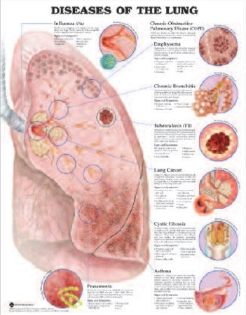 Anatomical Chart Company Anatomical Chart Lung Diseases 20 X 26 Inch Heavy Paper Grommets Laminated - 9781587799082