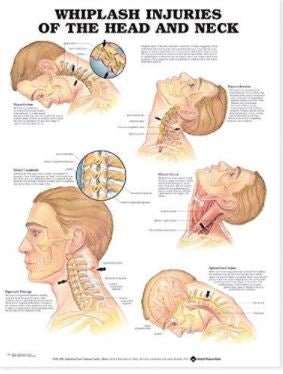 Anatomical Chart Company Anatomical Chart Co Anatomical Chart Whiplash Injuries of the Head and Neck - 9781587793769