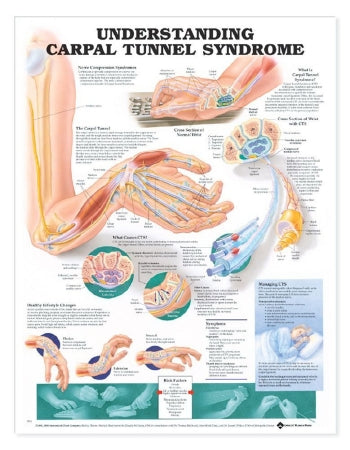 Anatomical Chart Company Anatomical Chart Carpal Tunnel Syndrome 20 X 26 Inch Heavy Paper Grommets Laminated - 9781587793226