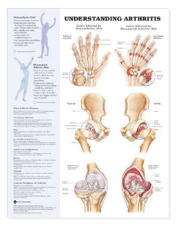 Anatomical Chart Company Anatomical Chart Arthritis 20 X 26 Inch Heavy Paper Grommets Laminated - 9781587793851