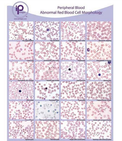 Market Lab Inc Anatomical Chart Blood Abnormal WBC Morphology Laminated - 7813