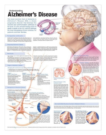 Anatomical Chart Company Anatomical Chart Alzheimer's Disease 20 X 26 Inch Heavy Paper Grommets Laminated - 9780781786331