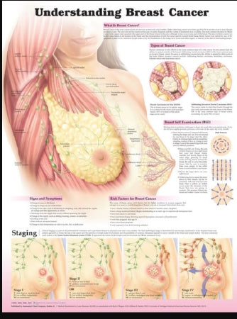 Anatomical Chart Company Anatomical Chart Breast Cancer 20 X 26 Inch Heavy Paper Grommets Laminated - 9781451185652