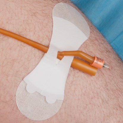 Baxter GRIP-LOK Catheter Stabilization Device 6.25 Long, Sterile, Breathable, Hypoallergenic Adhesive - 3400LFC