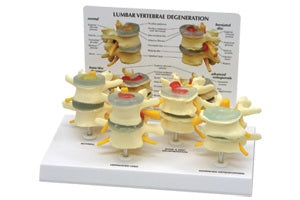 Dynatronics 4 Stage Degenerative Vertebrae Set Life Size - DLM1