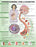 Anatomical Chart Company - Anatomical Chart Type 2 Diabetes 20 X 26 Inch Heavy Paper Grommets Laminated - 9781469894980