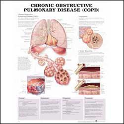 Anatomical Chart Company Anatomical Chart Chronic Obstructive Pulmonary Disease 20 X 26 Inch Plastic Wall Mount Laminated - 9780781782371