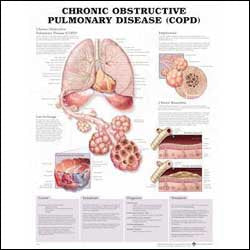 Anatomical Chart Company - Anatomical Chart Chronic Obstructive Pulmonary Disease 20 X 26 Inch Plastic Wall Mount Laminated - 9780781782371