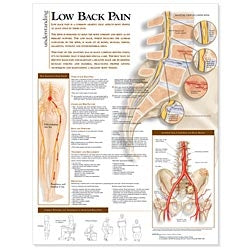 Anatomical Chart Company - Anatomical Chart Understanding Low Back Pain 20 X 26 Inch Heavy Paper Grommets Laminated - 9780781782432