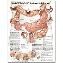 Anatomical Chart Company Anatomical Chart Understanding Colorectal Cancer 20 X 26 Inch Heavy Paper Grommets Laminated - 9780781773348