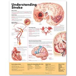 Anatomical Chart Company Anatomical Chart Understanding Stroke 20 X 26 Inch Heavy Paper Grommets Laminated - 9781587799884
