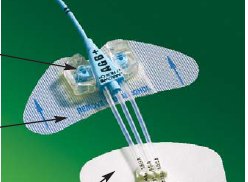 StatLock CV Plus - Catheter / Line Securement Device - CV0226