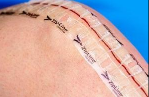Stryker Skin Closure Zip Strip Zipline Medical 1 Inch X 16 Cm Zip Close Strip Translucent - PS1160