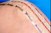 Stryker Skin Closure Zip Strip Zipline Medical 1 Inch X 24 Cm Zip Close Strip Translucent - PS1240