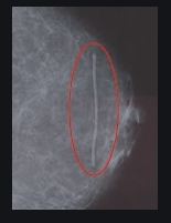 Precision Dynamics Spee-D-Line Swirl Collection Mammography Scar Marker 1.0 mm Line - SDW-SSD3