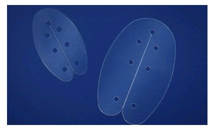 Summit Medical - Internal Nasal Splint Bivalve Splint Plastic Oversize ...