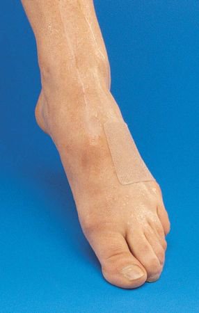 Aetna Felt Corporation Moorebrand Adhesive Dressing 2 X 3 Inch Fabric Rectangle Tan - 900649