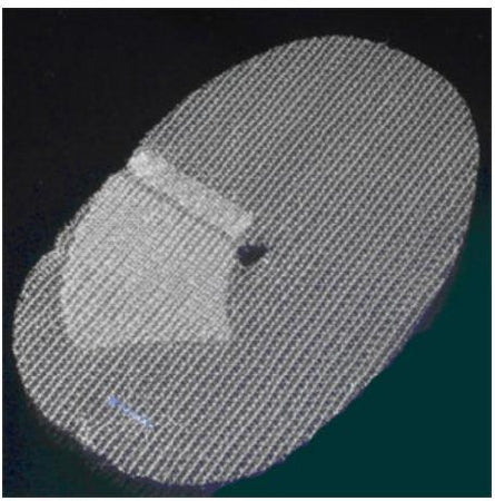 Covidien Parietex ProGrip Precut Self - Fixating Hernia Repair Mesh Partially Absorbable Knitted Polyester Monofilament / Polylactic Acid (PLA) 3-1/2 X 5-1/2 Inch Left, Precut with Flap Style - TEM1409GL