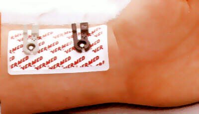 P.N.S - Electrotherapy Electrode - A10011