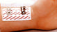 P.N.S - Electrotherapy Electrode - Vermont Medical - A10011