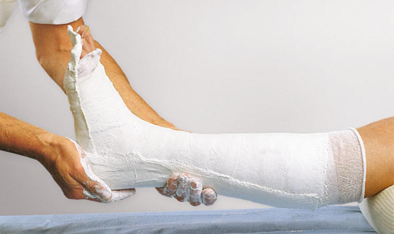 Splinting Material